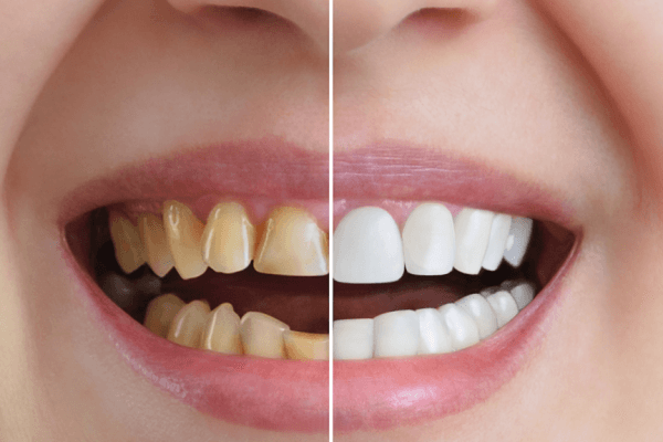 Quality Fluoride Treatment Care in Faridabad | Dr. Rajiv Ahuja - Special 50% Offer