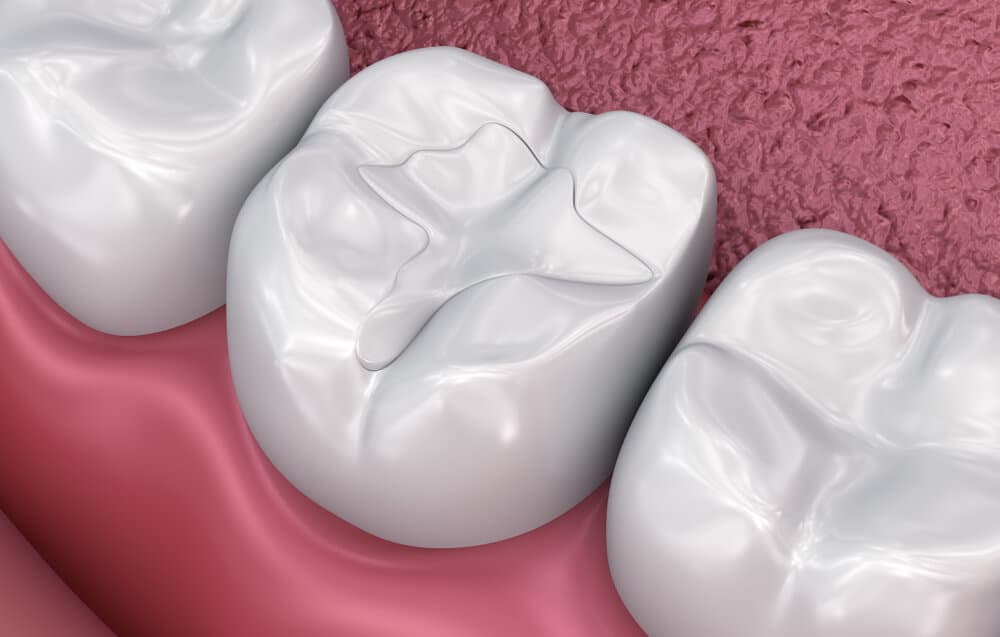 Complete Guide to Fillings Treatment in New Delhi | Dr. Abhishek Mathur